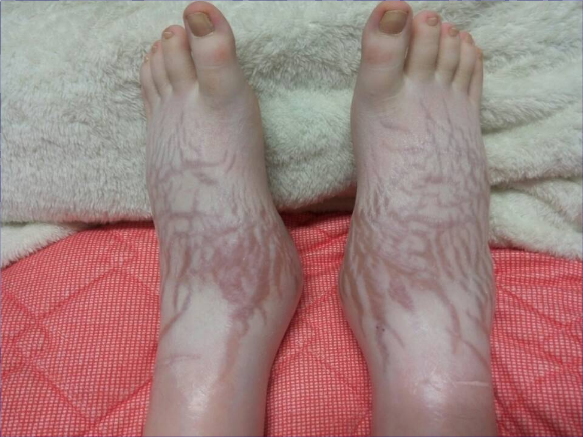 肾病综合症2演示稿.ppt