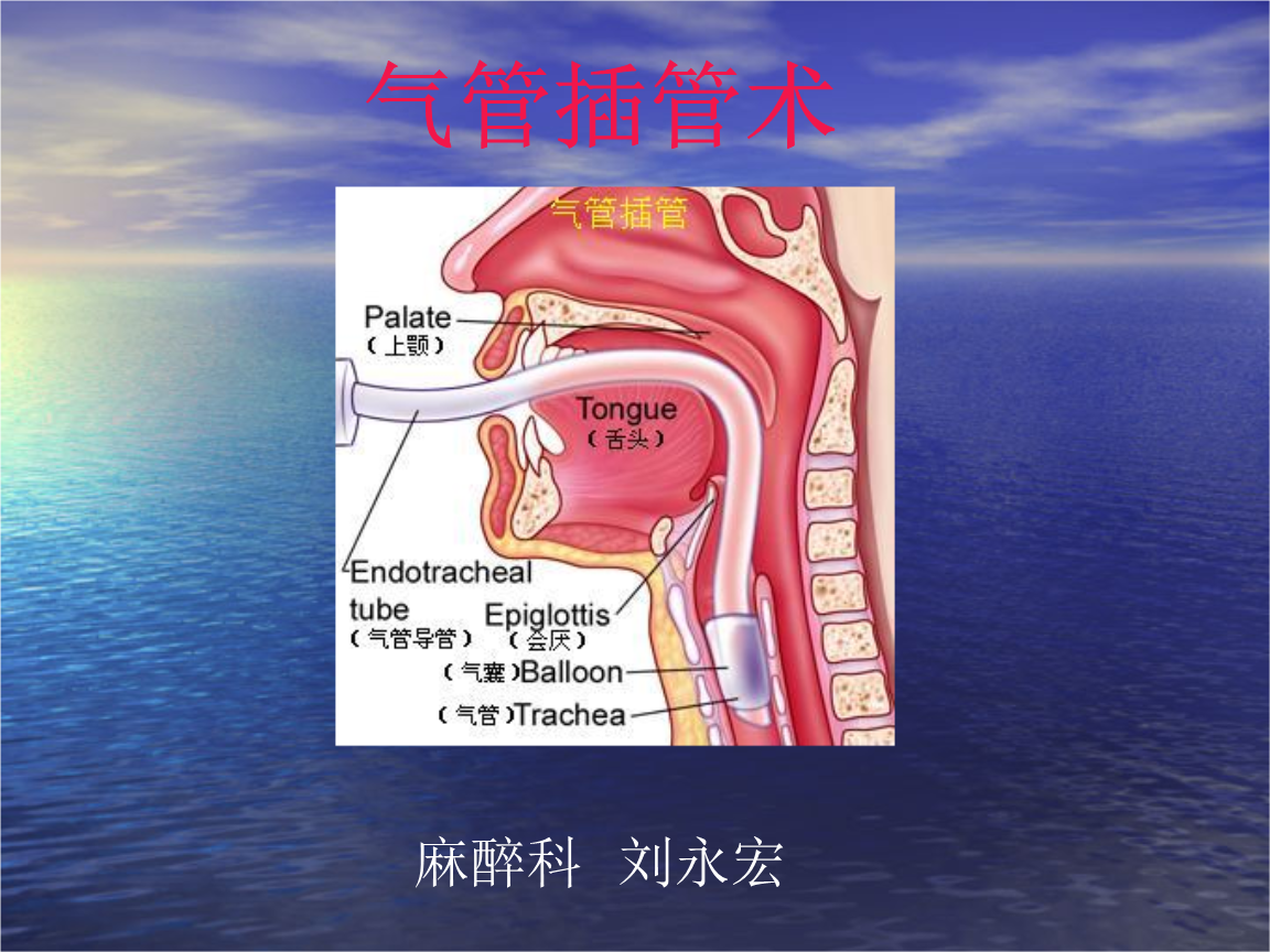 气管插管术_6课件.ppt